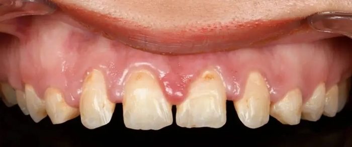 درمان فاصله دندان ها