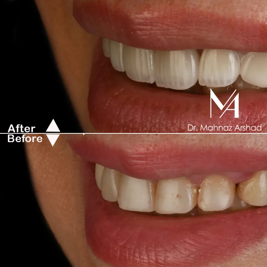 Veneers2
