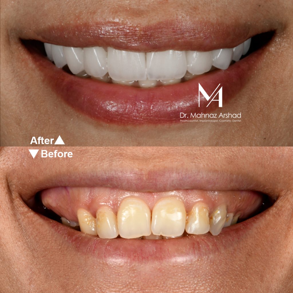 Veneers4