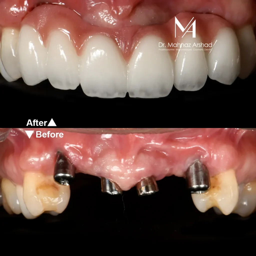 Veneers3