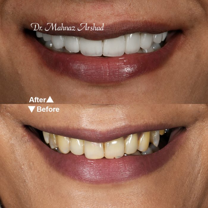 قبل و بعد روکش دندان برای زیباسازی لبخند