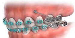 مینی اسکرو‌ها برای اصلاح موقعیت دندان ‌های عقب دهان