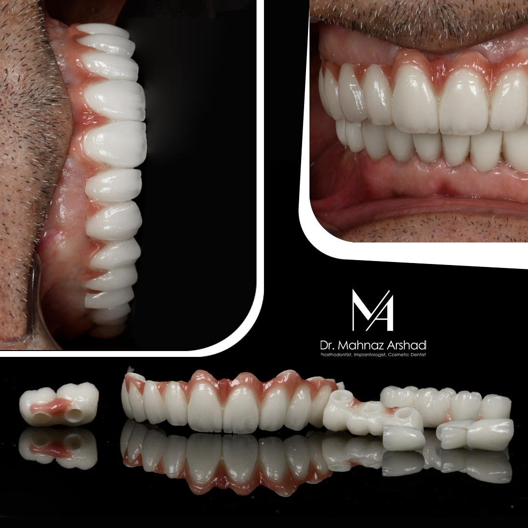 ایمپلنت دندان جایگزین دندان های از دست رفته