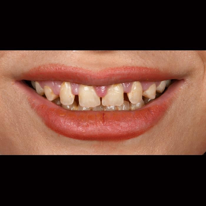 فاصله بین دندان ها