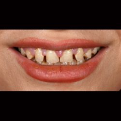 عکس فاصله بین دندانی