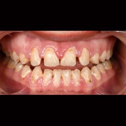 از بین بردن فاصله دندان ها