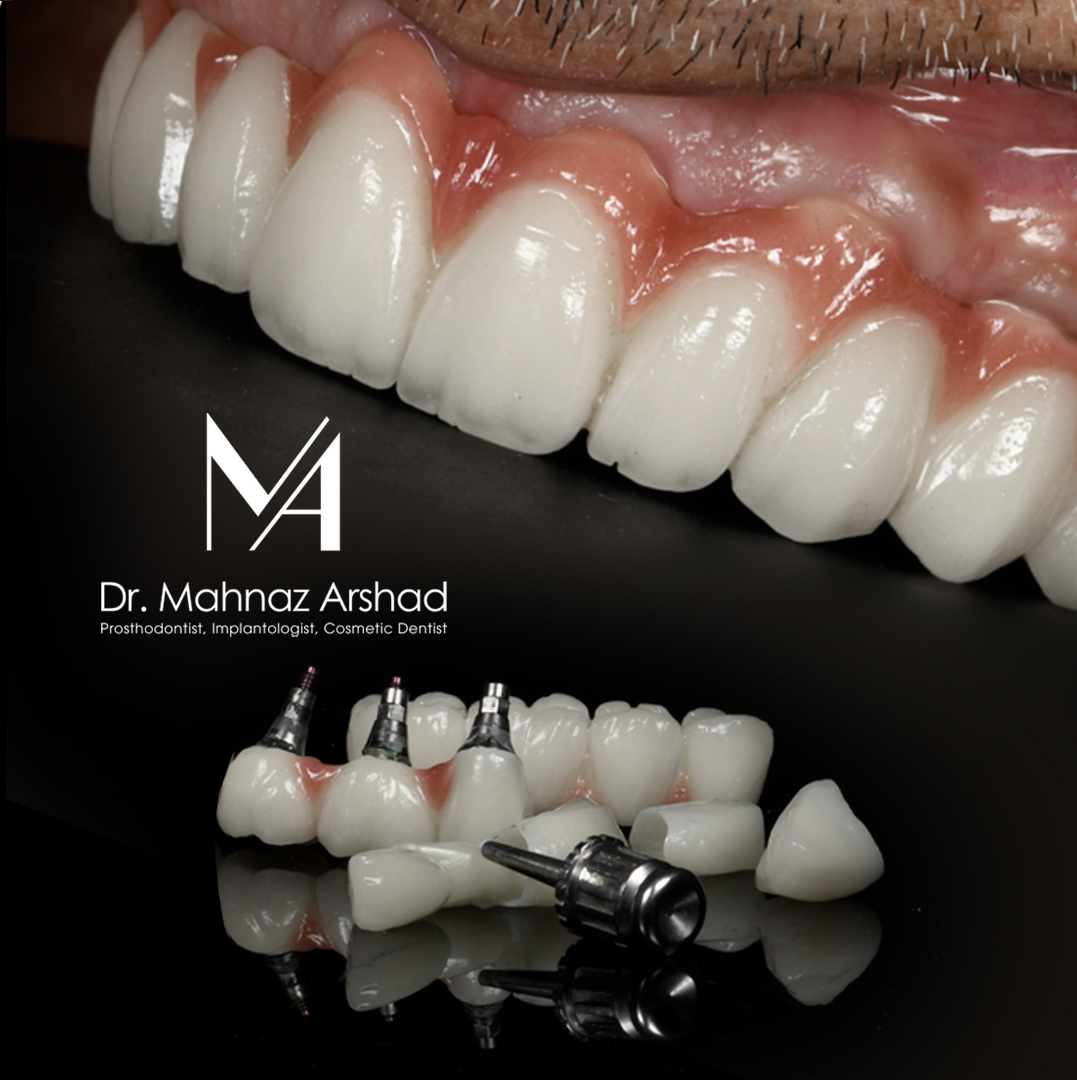 بهبودی بعد از ایمپلنت دندان