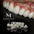 محدودیت ها و ممنوعیت ها ی پس از ایمپلنت دندان
