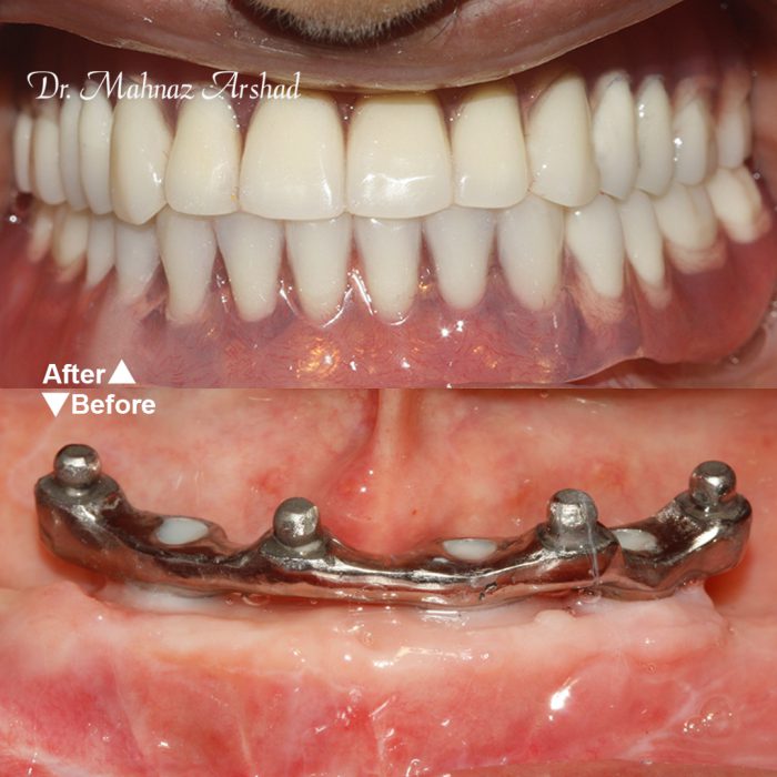 اوردنچر دندان برای بی دندانی
