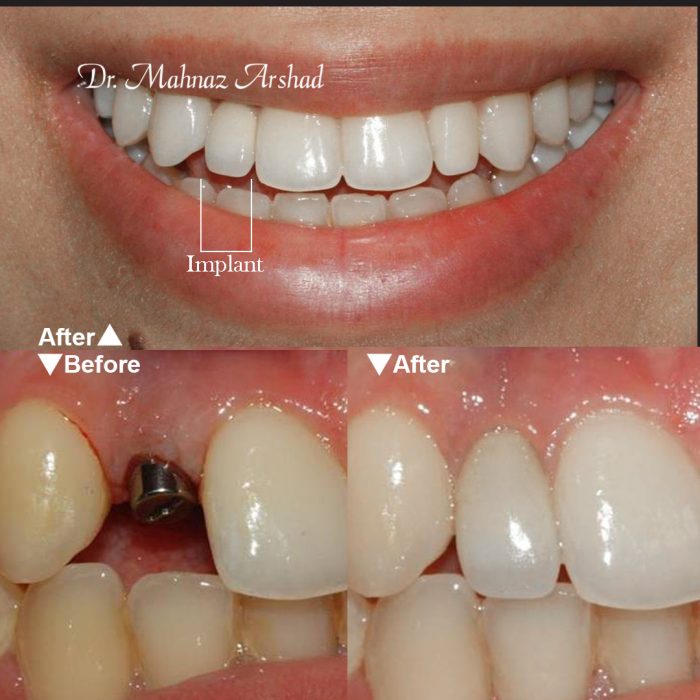 قبل و بعد از انجام ایمپلنت دندان