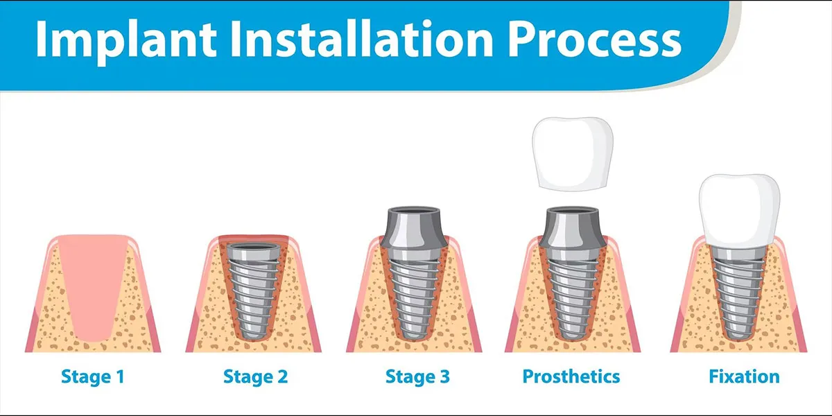 مراحل  ایمپلنت دندان