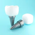 روش جدید ایمپلنت دندان