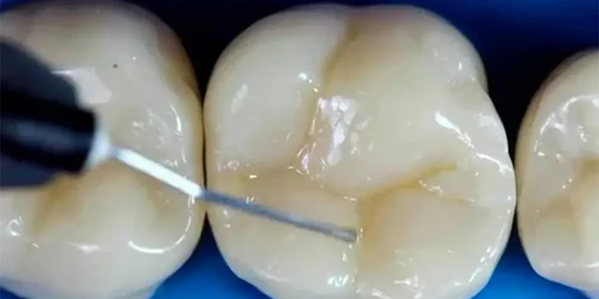 جایگاه کامپوزیت دندان در ترمیمات جزئی و کامل - دکتر مهنار ارشد