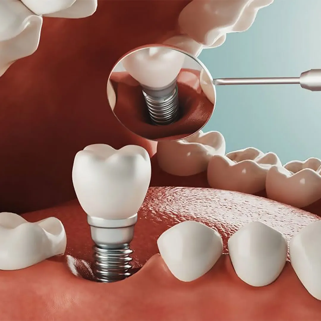 آخرین تکنولوژی‌ ها و روش ‌های پیشرفته در ایمپلنت دندان