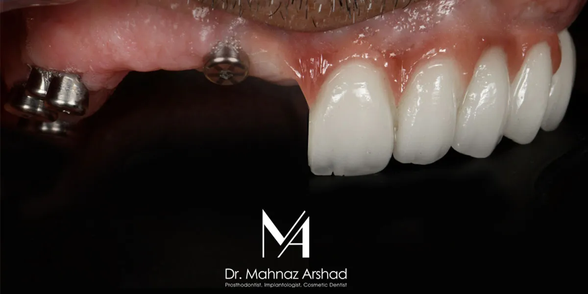 عمر ایمپلنت دندان چقدر است؟