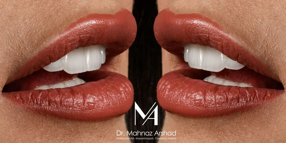 بلیچینگ دندان