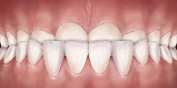 آندربایت دندان