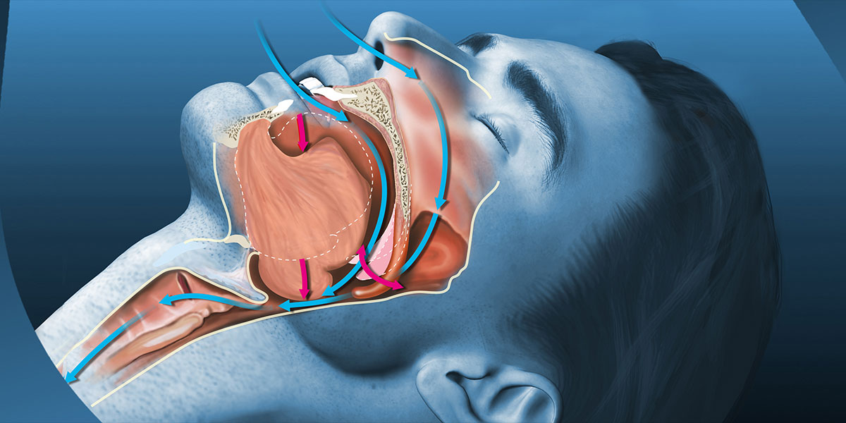 عوامل ایجاد خروپف