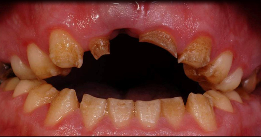 اپن بایت دندان چگونه ناهنجاری است؟