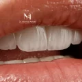 تخفیف جمعه سیاه: خدمات دندانپزشکی با 25% تخفیف خدمات دندانپزشکی زیبایی، لمینیت، کامپوزیت و اصلاح طرح لبخند