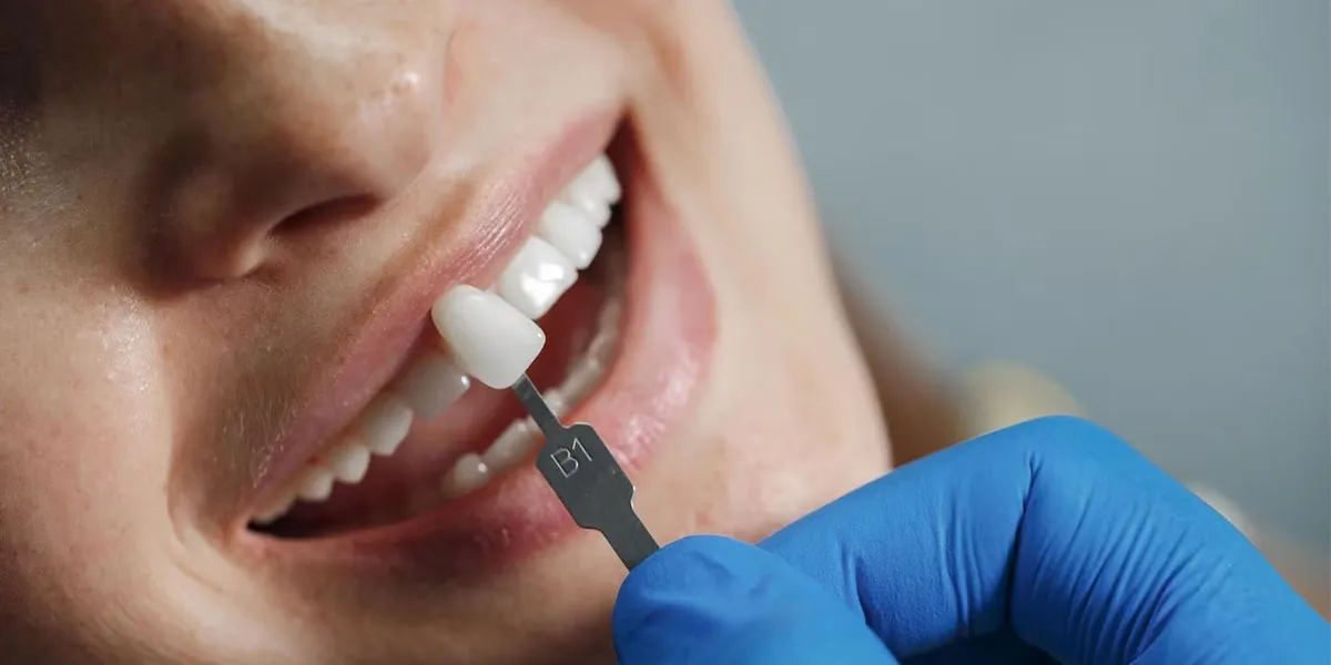 مزایای بلیچینگ دندان