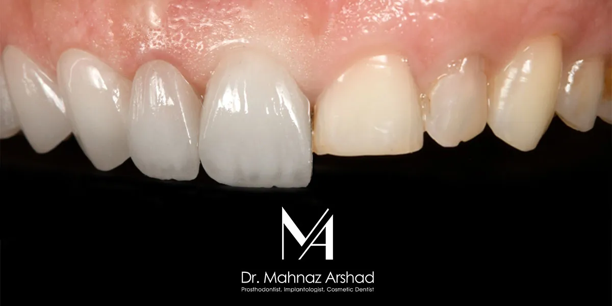 لمینیت سرامیکی دندان دقیقا چه کاربردی دارد و چه مشکلاتی را برطرف می ‌کند؟