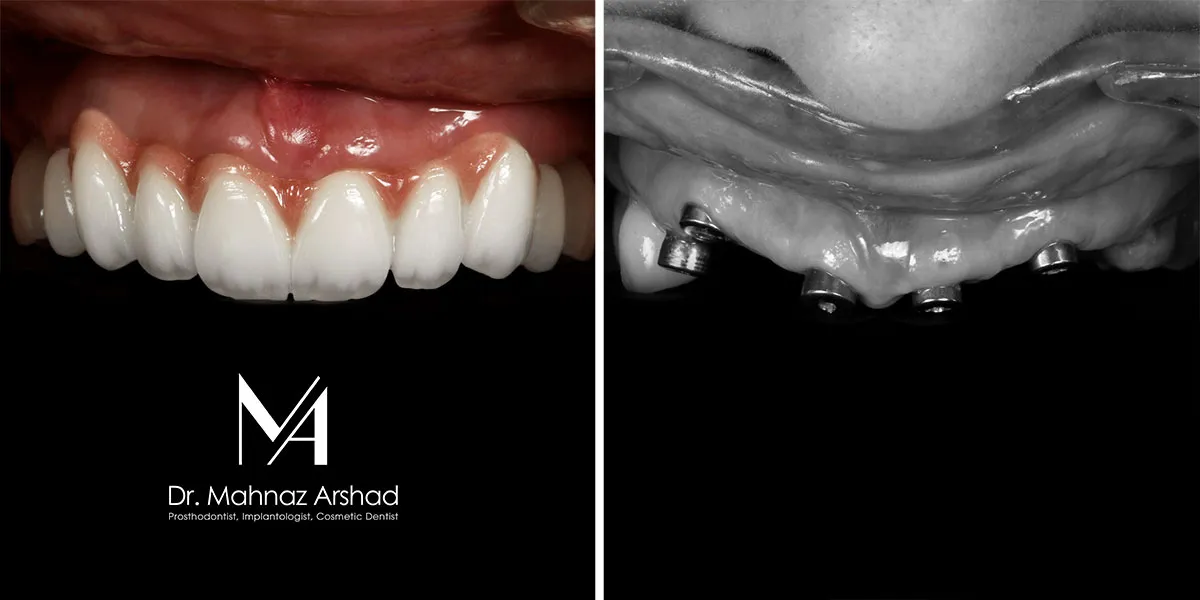 تفاوت های ایمپلنت معمولی و ایمپلنت دندان دیجیتال