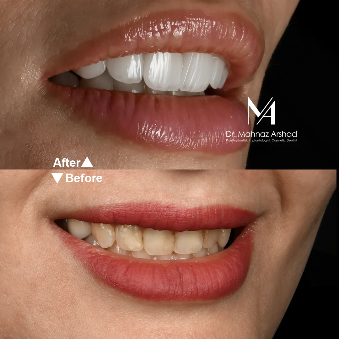 راهنمای کامل برای درمان لمینیت دندان