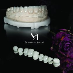 لمینیت دندان یکی از روش های زیبایی پر طرفدار در دندانپزشکی زیبایی