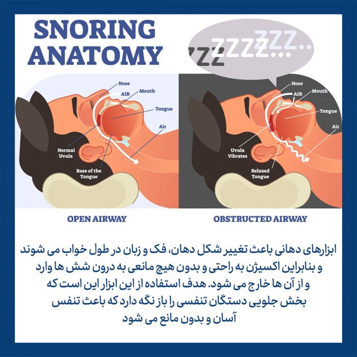 ابزارهای دهانی برای جلوگیری از آپنه خواب