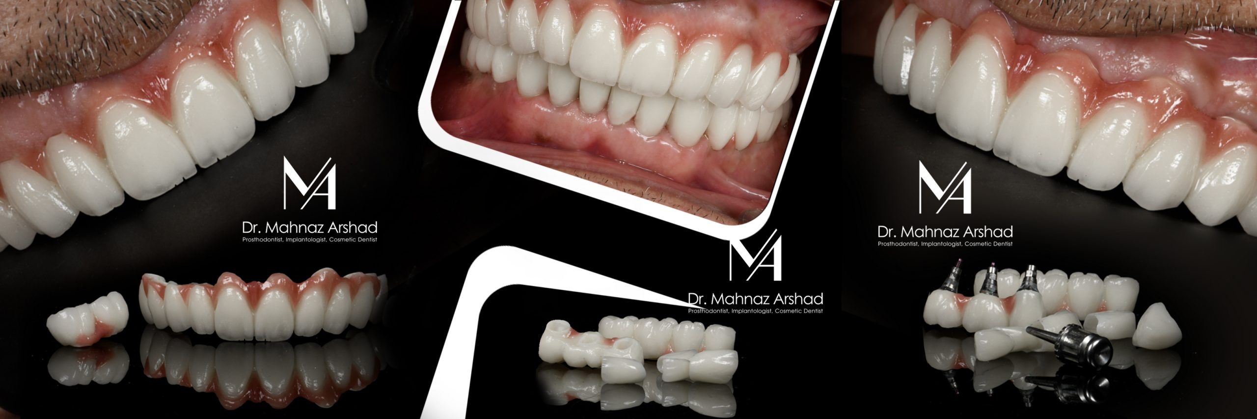 اگر ایمپلنت دندان پس زده شود چه کنیم؟