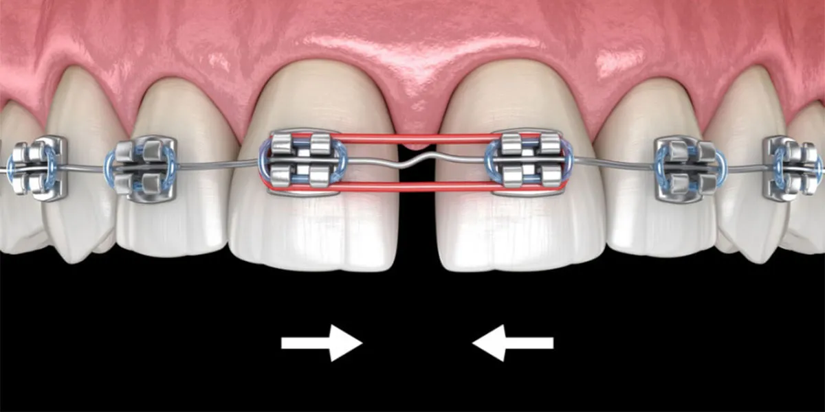 روش ‌های از بین بردن فاصله دندان ارتودنسی دندان