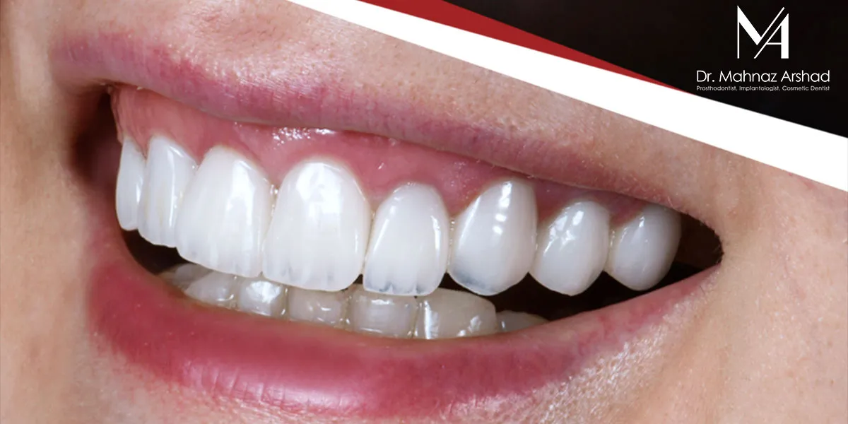 مزایا و معایب کامپوزیت دندان در افراد مسن