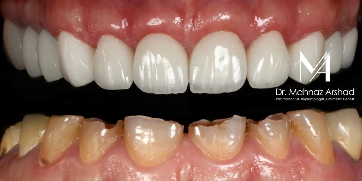 کامپوزیت دندان