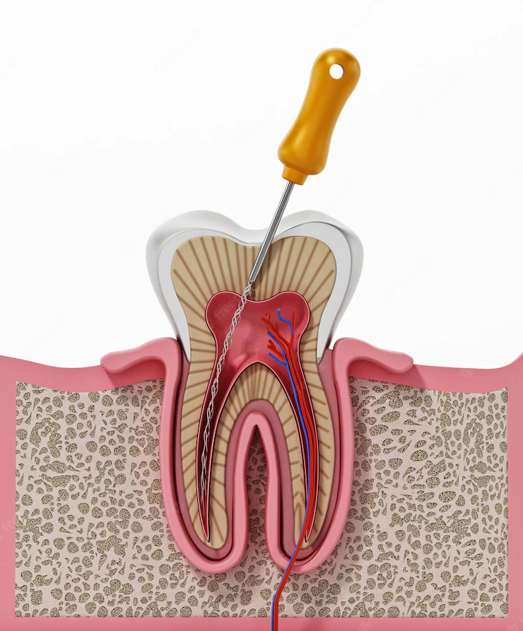 آبسه دندان چیست و چه راههایی برای درمان آن وجود دارد؟
