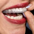 دندان قروچه را چگونه از بین ببریم؟