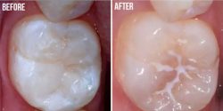 فیشور سیلانت برای جلوگیری از پوسیدگی دندان ها