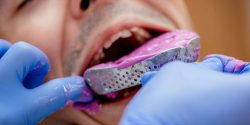 قالبگیری از دندان به روش سنتی