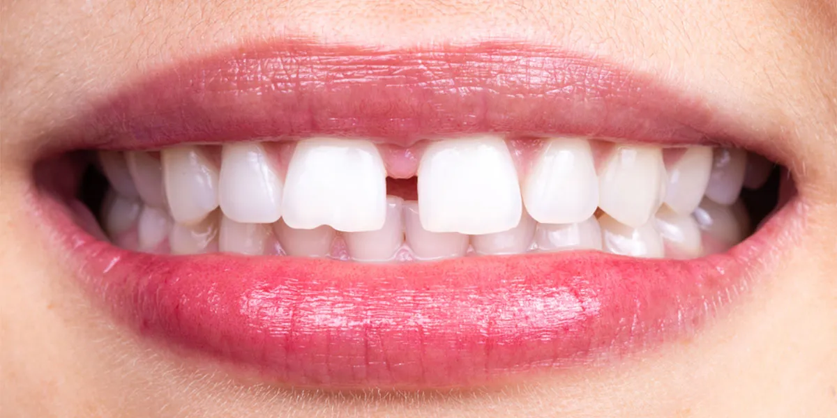 عوارض و مشکلات ناشی از فاصله بین دندان ‌ها