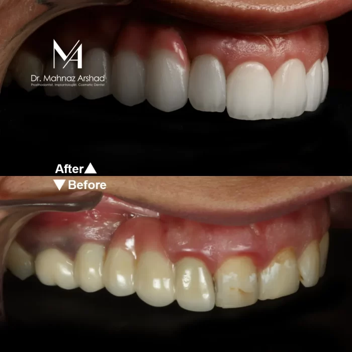 ایمپلنت دندان: جایگزینی دائمی برای دندان های از دست رفته