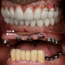 مراحل انجام ایمپلنت دندان