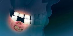 ایمپلنت، بهترین روش جایگزینی دندان