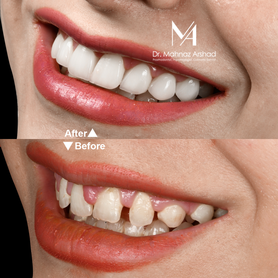 کامپوزیت ونیر دندان