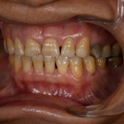 زرد شدن و تغغیر رنگ دندان ها از علایم ساییدگی دندان ها