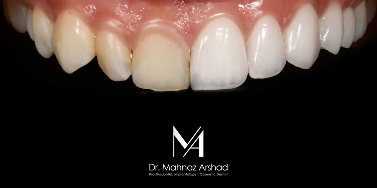 پوسیدگی دندان بر اثر کامپوزیت علت خرابی دندان بعد از کامپوزیت
