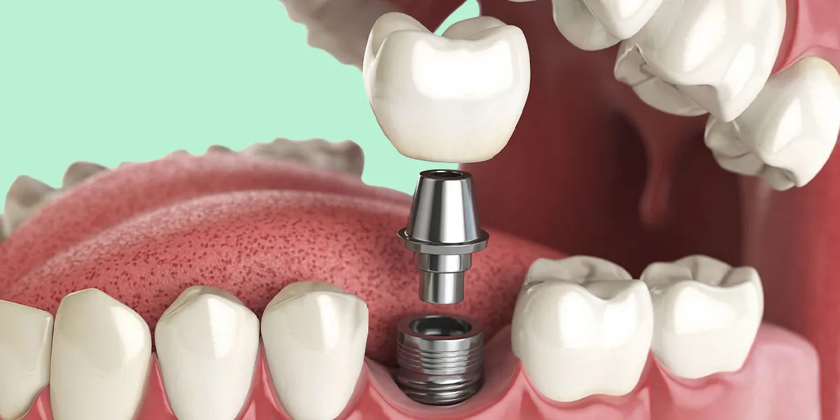 ایمپلنت دندان چگونه انجام می شود؟
