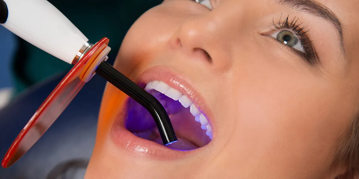 عوامل موثر بر مدت زمان ماندگاری کامپوزیت دندان