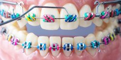 ارتودنسی روشی برای رفع آندربایت دندان