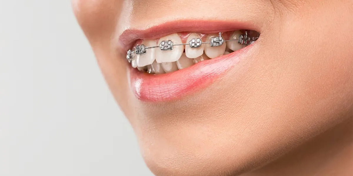 چرا به ارتودنسی دندان نیاز داریم؟