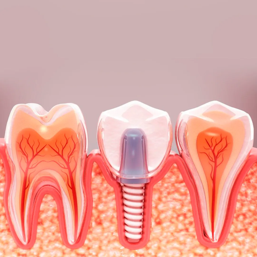 نقش فناوری ‌های دیجیتال در بهبود عملکرد و دقت در ایمپلنت دندان